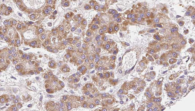 CACNA1G / Cav3.1 Antibody - 1:100 staining human liver carcinoma tissues by IHC-P. The sample was formaldehyde fixed and a heat mediated antigen retrieval step in citrate buffer was performed. The sample was then blocked and incubated with the antibody for 1.5 hours at 22°C. An HRP conjugated goat anti-rabbit antibody was used as the secondary.