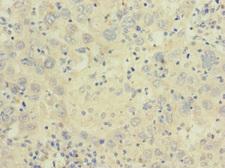CACNA2D2 Antibody - Immunohistochemistry of paraffin-embedded human liver cancer at dilution 1:100