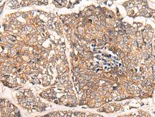 CACNA2D2 Antibody - Immunohistochemistry of paraffin-embedded Human esophagus cancer tissue  using CACNA2D2 Polyclonal Antibody at dilution of 1:45(×200)