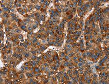 CACNB2 Antibody - Immunohistochemistry of paraffin-embedded Human lung cancer using CACNB2 Polyclonal Antibody at dilution of 1:30.