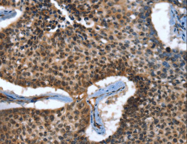 CACNB2 Antibody - Immunohistochemistry of paraffin-embedded Human lung cancer using CACNB2 Polyclonal Antibody at dilution of 1:30.