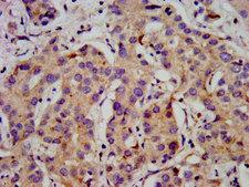 CACNB2 Antibody - Immunohistochemistry image at a dilution of 1:500 and staining in paraffin-embedded human liver cancer performed on a Leica BondTM system. After dewaxing and hydration, antigen retrieval was mediated by high pressure in a citrate buffer (pH 6.0) . Section was blocked with 10% normal goat serum 30min at RT. Then primary antibody (1% BSA) was incubated at 4 °C overnight. The primary is detected by a biotinylated secondary antibody and visualized using an HRP conjugated SP system.