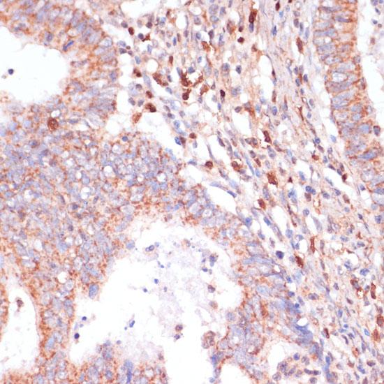 CACNB2 Antibody - Immunohistochemistry of paraffin-embedded Human colon carcinoma using CACNB2 Polyclonal Antibody at dilution of 1:100 (40x lens).