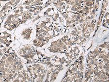 CACNB3 / Cavbeta3 Antibody - Immunohistochemistry of paraffin-embedded Human esophagus cancer tissue  using CACNB3 Polyclonal Antibody at dilution of 1:55(×200)