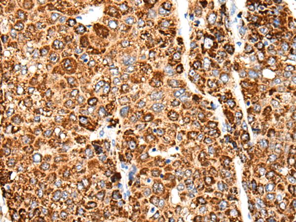 CACNG5 Antibody - Immunohistochemistry of paraffin-embedded Human liver cancer tissue  using CACNG5 Polyclonal Antibody at dilution of 1:50(×200)