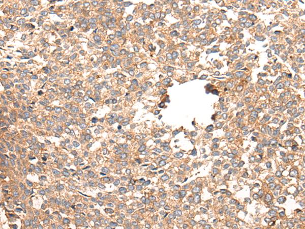 CACNG5 Antibody - Immunohistochemistry of paraffin-embedded Human esophagus cancer tissue  using CACNG5 Polyclonal Antibody at dilution of 1:50(×200)