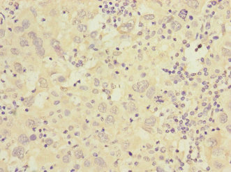CACNG7 Antibody - Immunohistochemistry of paraffin-embedded human liver cancer at dilution 1:100