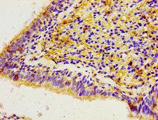 CACYBP Antibody - Immunohistochemistry image of paraffin-embedded human lung cancer at a dilution of 1:100