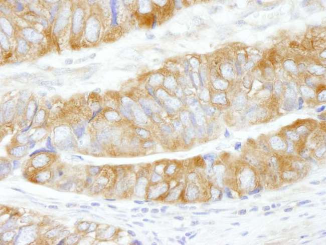 CAD Antibody - Detection of Human CAD by Immunohistochemistry. Sample: FFPE section of human colon carcinoma. Antibody: Affinity purified rabbit anti-CAD used at a dilution of 1:200 (1 ug/ml).