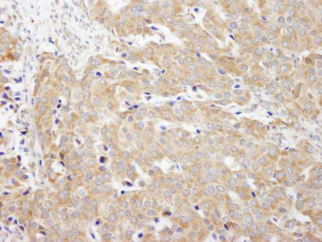 CAD Antibody - Detection of Human CAD by Immunohistochemistry. Sample: FFPE section of human breast carcinoma. Antibody: Affinity purified rabbit anti-CAD used at a dilution of 1:200 (1 ug/ml).