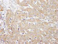 CAD Antibody - Detection of Human CAD by Immunohistochemistry. Sample: FFPE section of human breast carcinoma. Antibody: Affinity purified rabbit anti-CAD used at a dilution of 1:200 (1 ug/ml).