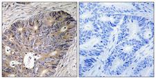 CAD Antibody - Immunohistochemistry analysis of paraffin-embedded human colon carcinoma tissue, using CAD Antibody. The picture on the right is blocked with the synthesized peptide.