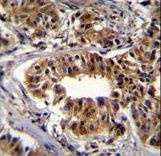 CAD Antibody - CAD Antibody immunohistochemistry of formalin-fixed and paraffin-embedded human breast carcinoma followed by peroxidase-conjugated secondary antibody and DAB staining.