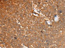 CAD Antibody - Immunohistochemistry of paraffin-embedded Human thyroid cancer tissue  using CAD Polyclonal Antibody at dilution of 1:50(×200)