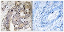 CAD Antibody - Immunohistochemistry analysis of paraffin-embedded human colon carcinoma, using CAD (Phospho-Thr456) Antibody. The picture on the right is blocked with the phospho peptide.