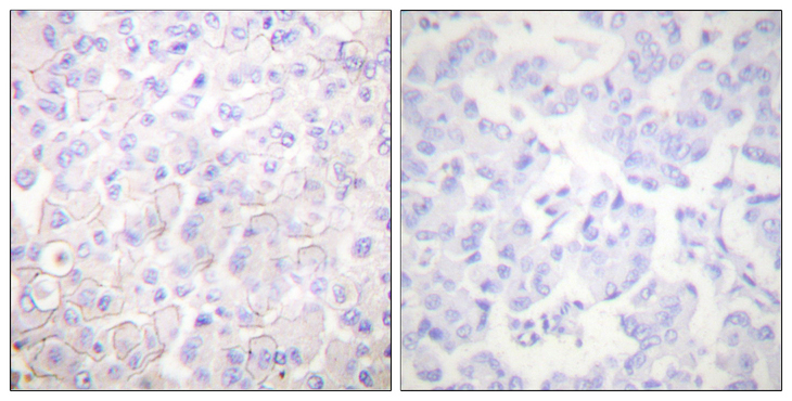 Cadherin Antibody - Immunohistochemistry analysis of paraffin-embedded human breast carcinoma tissue, using Cadherin-pan Antibody. The picture on the right is blocked with the synthesized peptide.