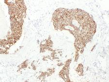 Cadherin Antibody - Breast Carcinoma 1
