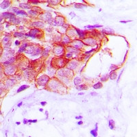 CADM2 Antibody - Immunohistochemical analysis of CADM2 staining in human prostate cancer formalin fixed paraffin embedded tissue section. The section was pre-treated using heat mediated antigen retrieval with sodium citrate buffer (pH 6.0). The section was then incubated with the antibody at room temperature and detected with HRP and DAB as chromogen. The section was then counterstained with hematoxylin and mounted with DPX.
