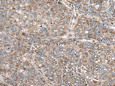 CADM2 Antibody - Immunohistochemistry of paraffin-embedded Human liver cancer tissue  using CADM2 Polyclonal Antibody at dilution of 1:40(×200)