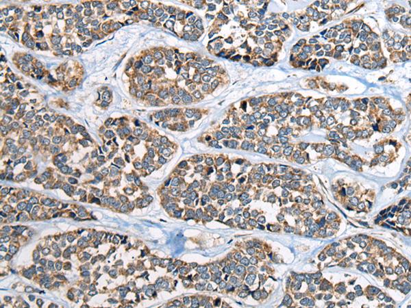 CADM2 Antibody - Immunohistochemistry of paraffin-embedded Human esophagus cancer tissue  using CADM2 Polyclonal Antibody at dilution of 1:40(×200)