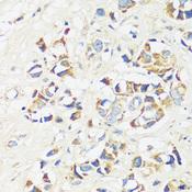 CADPS Antibody - Immunohistochemistry of paraffin-embedded Human breast cancer using CADPS Polyclonal Antibody at dilution of 1:100 (40x lens).