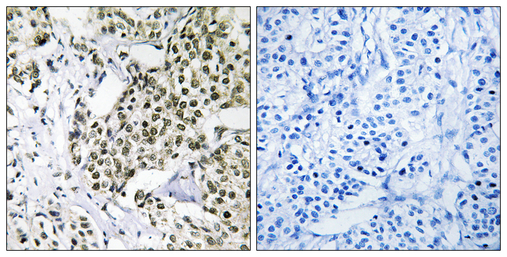 CAGE1 / Cancer Antigen 1 Antibody - Immunohistochemistry analysis of paraffin-embedded human breast carcinoma tissue, using CAGE1 Antibody. The picture on the right is blocked with the synthesized peptide.