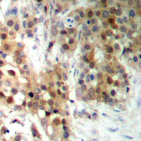 CAGE1 / Cancer Antigen 1 Antibody - Immunohistochemical analysis of CAGE1 staining in human prostate cancer formalin fixed paraffin embedded tissue section. The section was pre-treated using heat mediated antigen retrieval with sodium citrate buffer (pH 6.0). The section was then incubated with the antibody at room temperature and detected using an HRP conjugated compact polymer system. DAB was used as the chromogen. The section was then counterstained with hematoxylin and mounted with DPX.