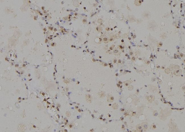 CAGE1 / Cancer Antigen 1 Antibody - 1:100 staining human lung tissue by IHC-P. The sample was formaldehyde fixed and a heat mediated antigen retrieval step in citrate buffer was performed. The sample was then blocked and incubated with the antibody for 1.5 hours at 22°C. An HRP conjugated goat anti-rabbit antibody was used as the secondary.