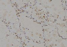 CAGE1 / Cancer Antigen 1 Antibody - 1:100 staining human lung tissue by IHC-P. The sample was formaldehyde fixed and a heat mediated antigen retrieval step in citrate buffer was performed. The sample was then blocked and incubated with the antibody for 1.5 hours at 22°C. An HRP conjugated goat anti-rabbit antibody was used as the secondary.