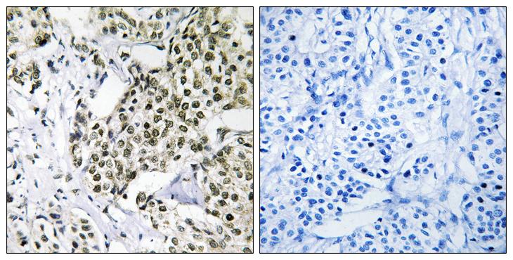 CAGE1 / Cancer Antigen 1 Antibody - Peptide - + Immunohistochemistry analysis of paraffin-embedded human breast carcinoma tissue using CAGE1 antibody.