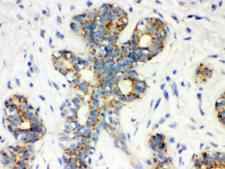 CALB1 / Calbindin Antibody - IHC testing of FFPE human breast cancer tissue with Calbindin antibody. HIER: Boil the paraffin sections in pH 6, 10mM citrate buffer for 20 minutes and allow to cool prior to testing.