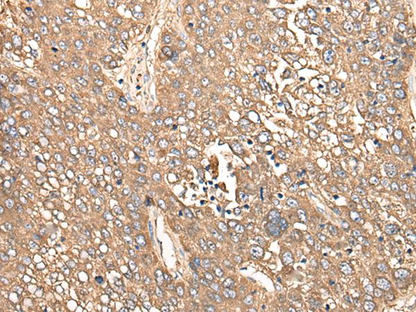 CALB1 / Calbindin Antibody - Immunohistochemistry of paraffin-embedded Human liver cancer tissue  using CALB1 Polyclonal Antibody at dilution of 1:80(×200)