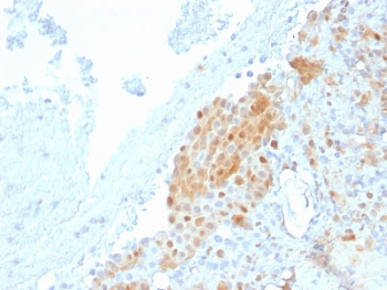 CALB2 / Calretinin Antibody - IHC testing of FFPE human Mesothelioma with Calbindin 2 antibody (clone CALB2/2685). HIER: boil tissue sections in pH6, 10mM citrate buffer, for 10-20 min followed by cooling at RT for 20 min.