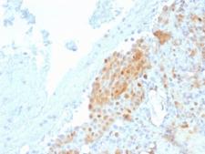 CALB2 / Calretinin Antibody - IHC testing of FFPE human Mesothelioma with Calbindin 2 antibody (clone CALB2/2685). HIER: boil tissue sections in pH6, 10mM citrate buffer, for 10-20 min followed by cooling at RT for 20 min.
