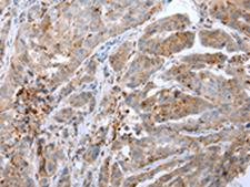 CALB2 / Calretinin Antibody - Immunohistochemistry of paraffin-embedded Human breast cancer tissue  using CALB2 Polyclonal Antibody at dilution of 1:25(×200)