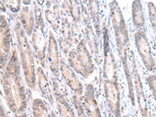 CALB2 / Calretinin Antibody - Immunohistochemistry of paraffin-embedded Human gastric cancer tissue  using CALB2 Polyclonal Antibody at dilution of 1:25(×200)