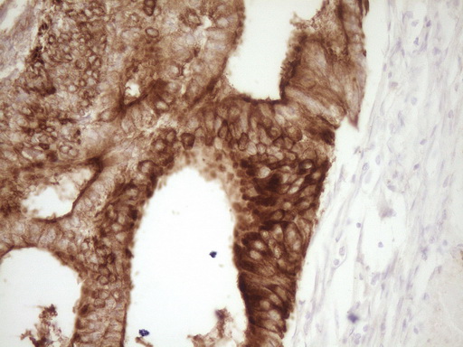 CALCA Antibody - IHC of paraffin-embedded Adenocarcinoma of Human colon tissue using anti-CALCA mouse monoclonal antibody. (Heat-induced epitope retrieval by Tris-EDTA, pH8.0).