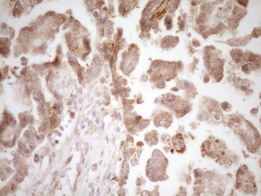 CALCA Antibody - IHC of paraffin-embedded Adenocarcinoma of Human ovary tissue using anti-CALCA mouse monoclonal antibody. (Heat-induced epitope retrieval by Tris-EDTA, pH8.0).
