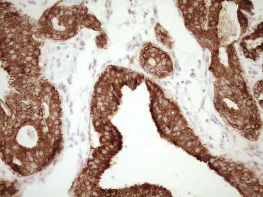 CALCA Antibody - IHC of paraffin-embedded Adenocarcinoma of Human breast tissue using anti-CALCA mouse monoclonal antibody. (Heat-induced epitope retrieval by Tris-EDTA, pH8.0).
