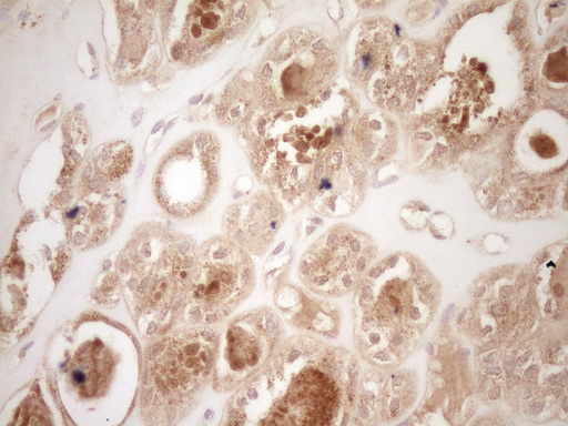 CALCA Antibody - IHC of paraffin-embedded Carcinoma of Human thyroid tissue using anti-CALCA mouse monoclonal antibody. (Heat-induced epitope retrieval by Tris-EDTA, pH8.0).