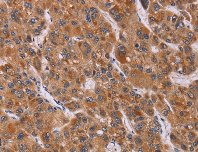 CALCA Antibody - Immunohistochemistry of paraffin-embedded Human breast cancer using CALCA Polyclonal Antibody at dilution of 1:40.