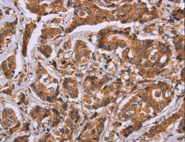 CALCA Antibody - Immunohistochemistry of paraffin-embedded Human breast cancer using CALCA Polyclonal Antibody at dilution of 1:40.
