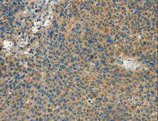 CALCA Antibody - Immunohistochemistry of paraffin-embedded Human thyroid cancer using CALCA Polyclonal Antibody at dilution of 1:60.