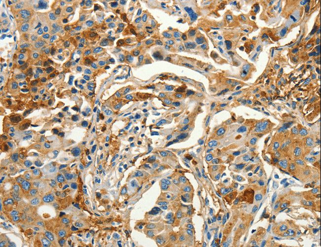 CALCA Antibody - Immunohistochemistry of paraffin-embedded Human lung cancer using CALCA Polyclonal Antibody at dilution of 1:60.