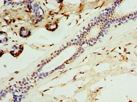 CALCB Antibody - Immunohistochemistry of paraffin-embedded human breast cancer using antibody at 1:100 dilution.