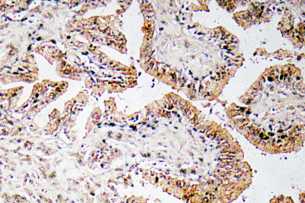 Calcitonin Antibody - Immunohistochemistry analysis of Calcitonin antibody in paraffin-embedded human prostate carcinoma tissue.