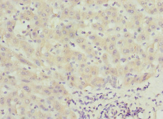 CALCOCO1 / CoCoa Antibody - Immunohistochemistry of paraffin-embedded human liver cancer at dilution 1:100