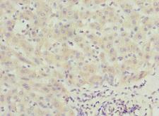 CALCOCO1 / CoCoa Antibody - Immunohistochemistry of paraffin-embedded human liver cancer at dilution 1:100