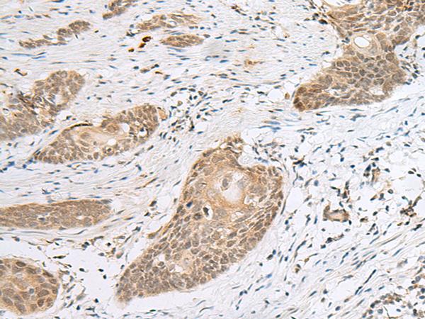 CALCOCO1 / CoCoa Antibody - Immunohistochemistry of paraffin-embedded Human esophagus cancer tissue  using CALCOCO1 Polyclonal Antibody at dilution of 1:50(×200)