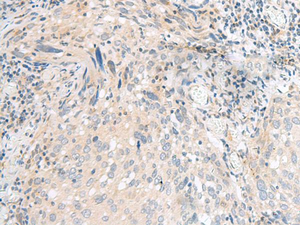 CALCOCO1 / CoCoa Antibody - Immunohistochemistry of paraffin-embedded Human cervical cancer tissue  using CALCOCO1 Polyclonal Antibody at dilution of 1:40(×200)